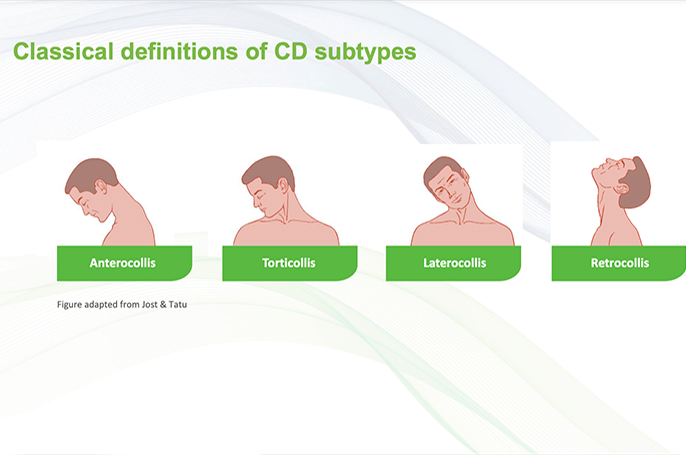 Cervical Dystonia Disease Background – eLearning Module