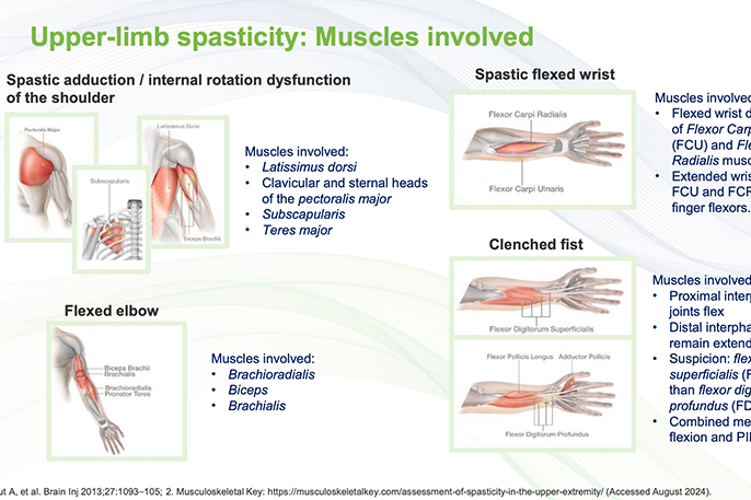 Diagnosis and assessment of spasticity in adults – eLearning Module